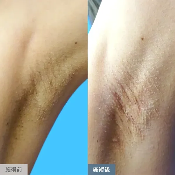TCBのわきが・多汗症治療の症例写真