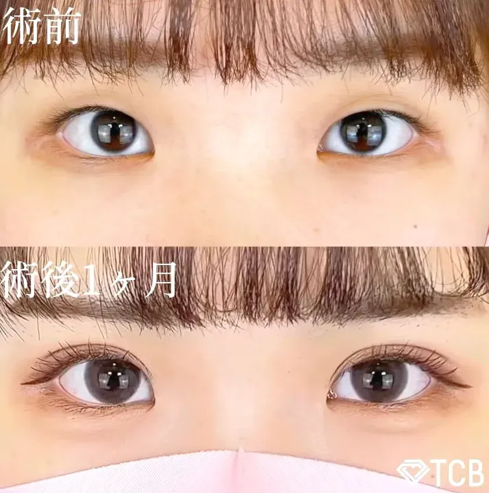 二重整形が無料で受けられると話題のTCBの症例写真