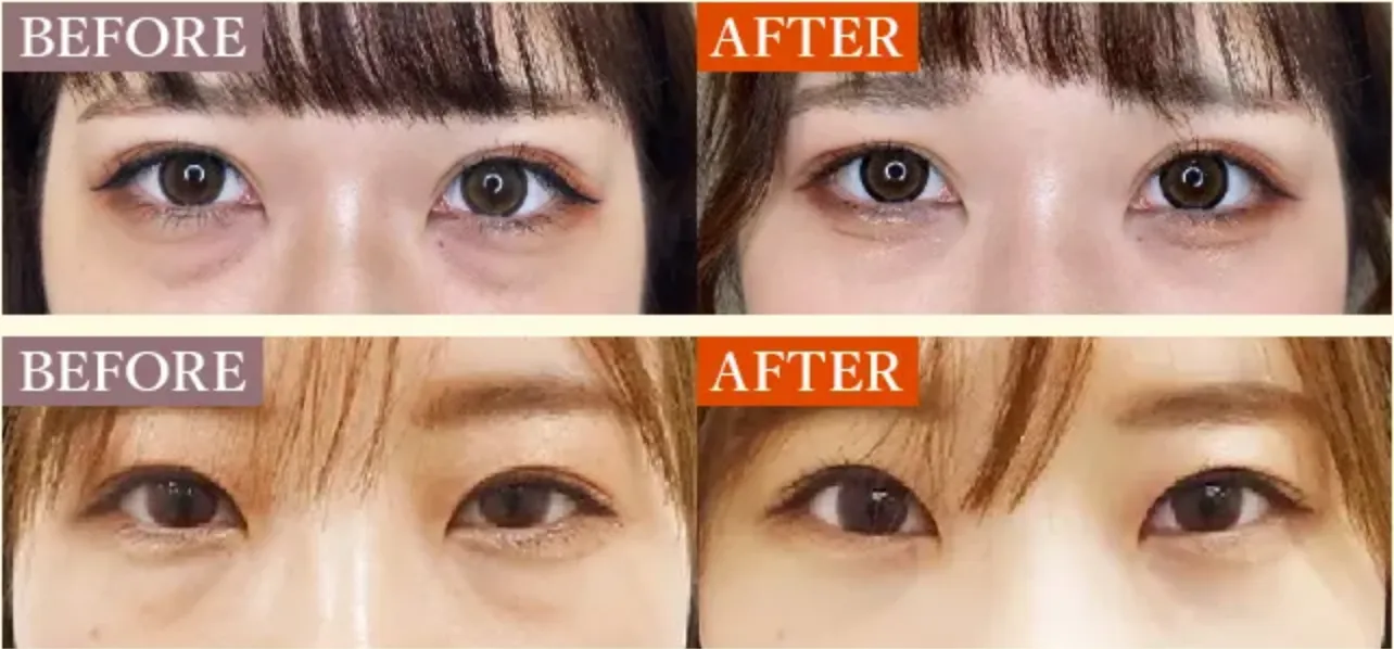 TCB クマ取り再生注射