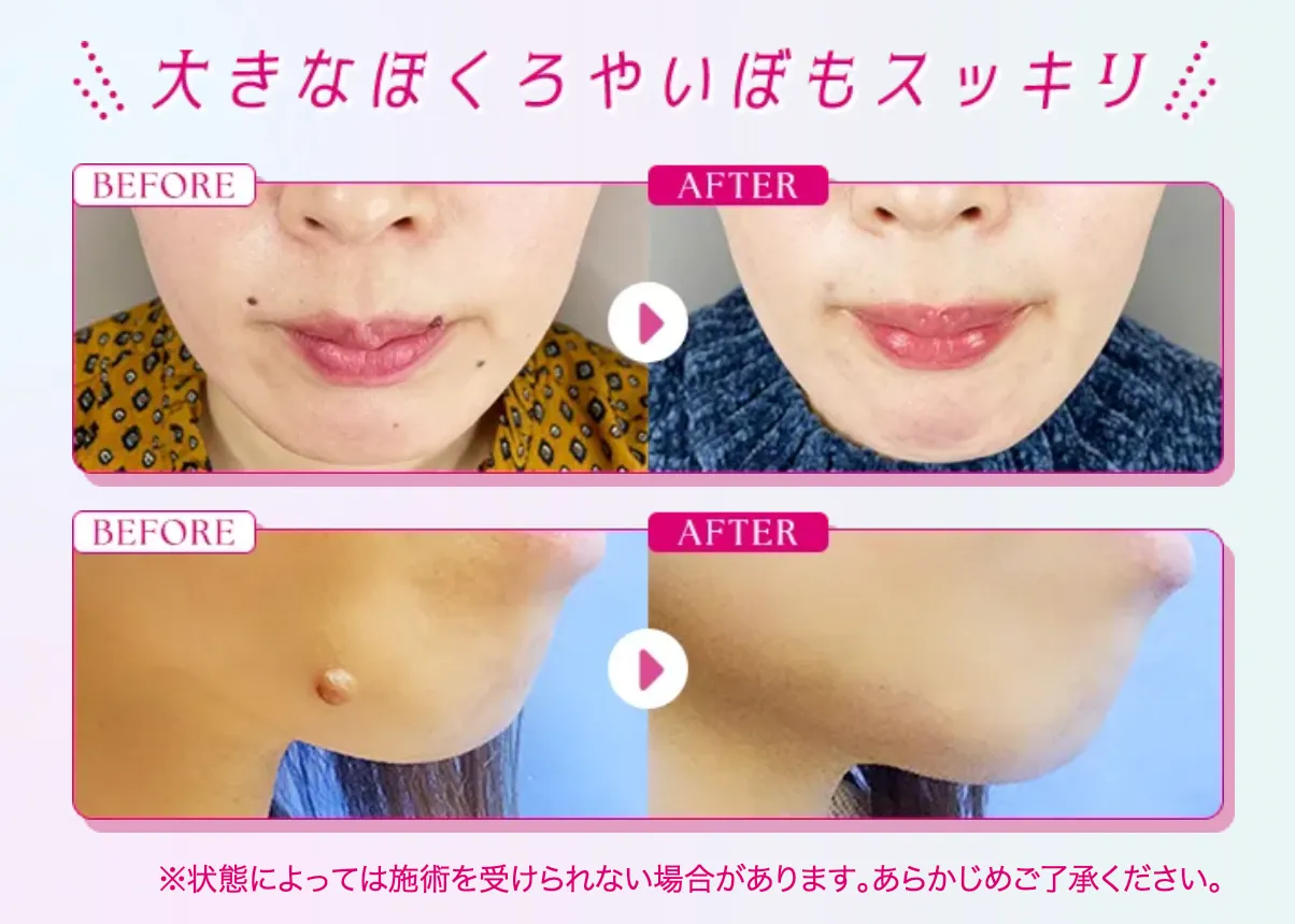 TCB ほくろ・いぼ除去