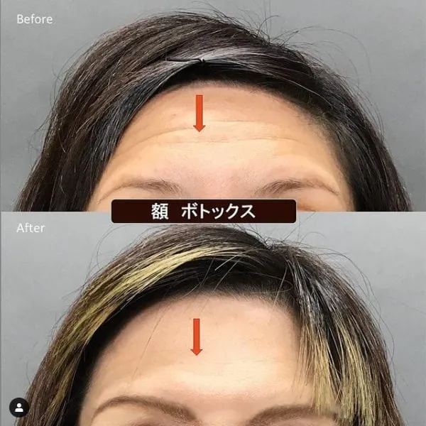 TCB しわ取り(ボトックス注射)