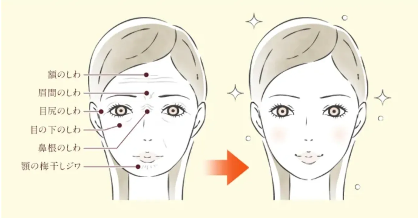 TCB しわ取り(ボトックス注射)