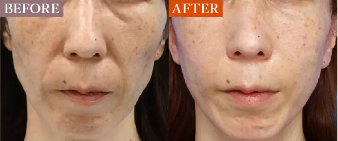 TCB ヒアルロン酸注射