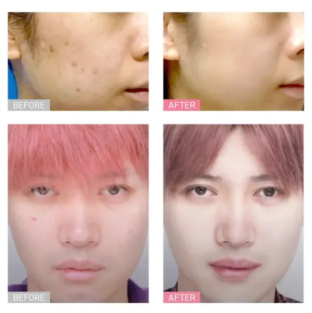 TCB ハイドラジェントル（ハイドラフェイシャル） 症例写真