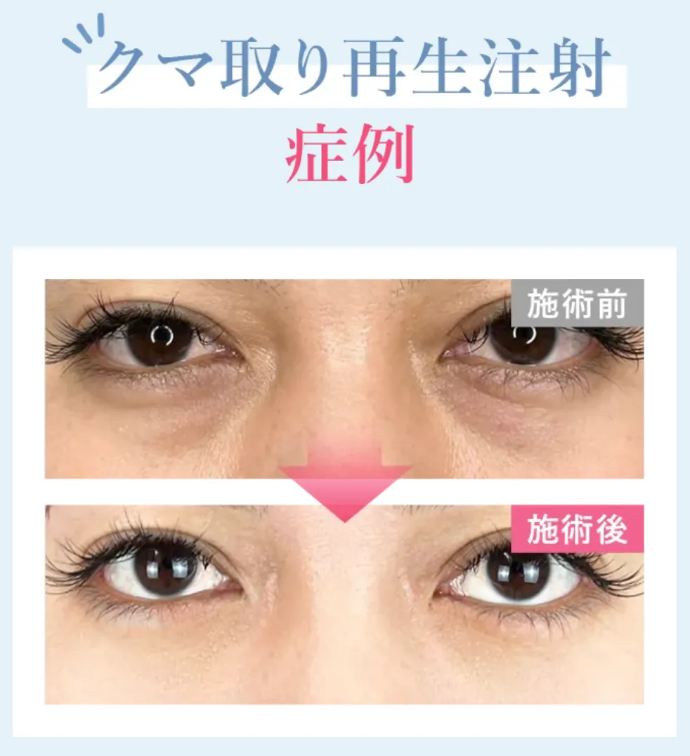 TCB クマ取り再生注射 症例写真