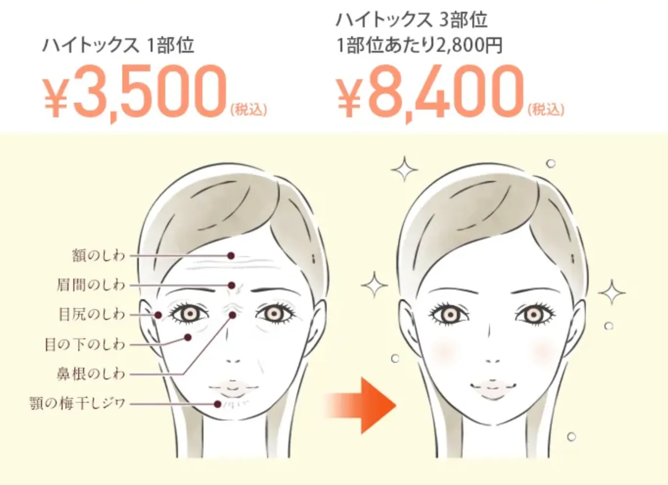 TCB しわ取り(ボトックス注射)料金