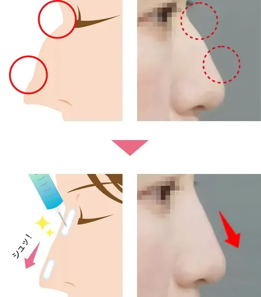 TCBメッシュの鼻整形とは、メッシュ素材が挿入されると時間が経つにつれて自分の組織に馴染み、自然な形を維持する施術のこと