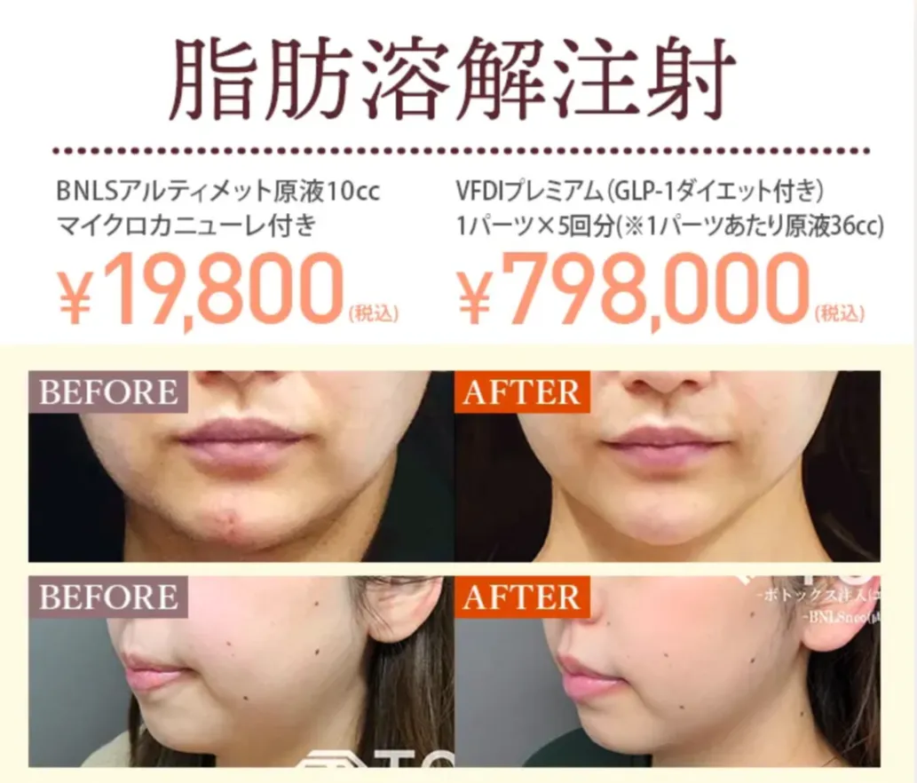 TCBの医療ローンで受けられる人気施術｜脂肪溶解注射施術症例