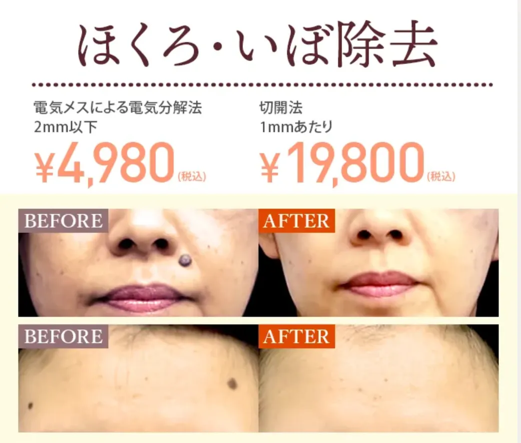 TCBの医療ローンで受けられる人気施術｜ほくろ・いぼ除去施術症例