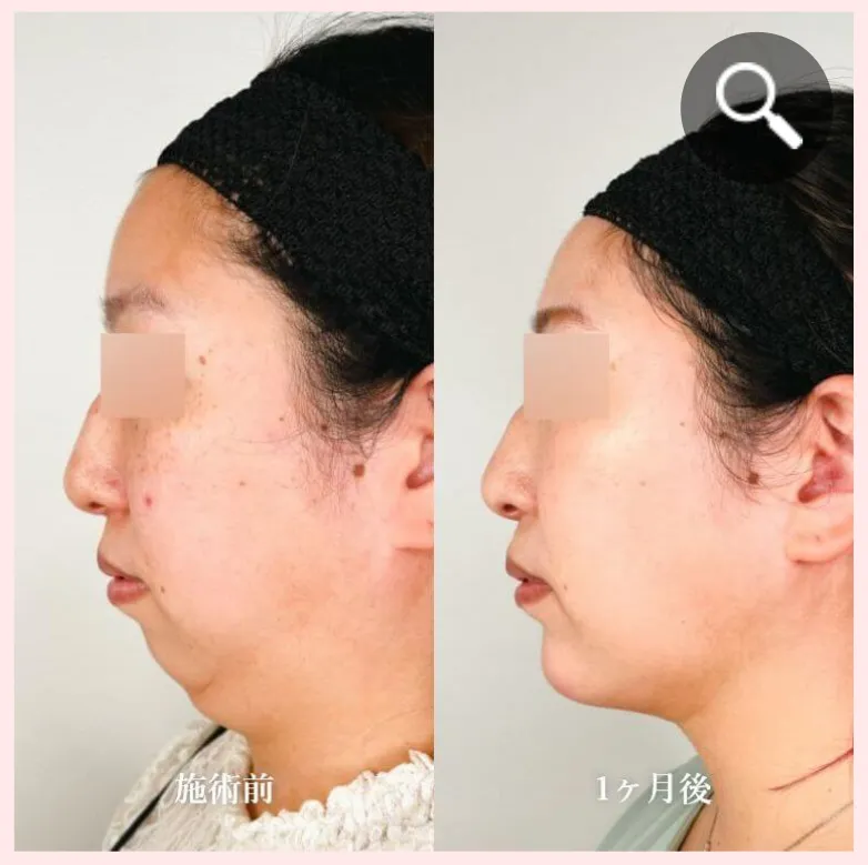 TCBの脂肪吸引注射症例②