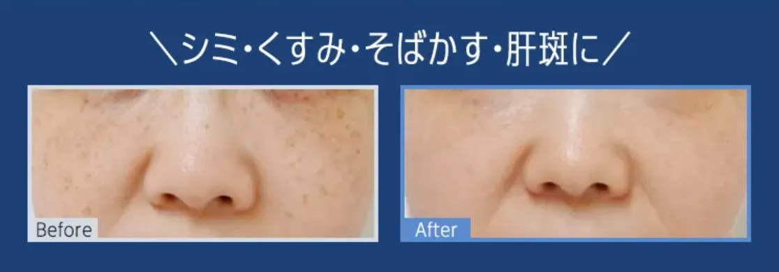 TCBの医療ローンで受けられる人気施術｜ピコレーザー施術症例