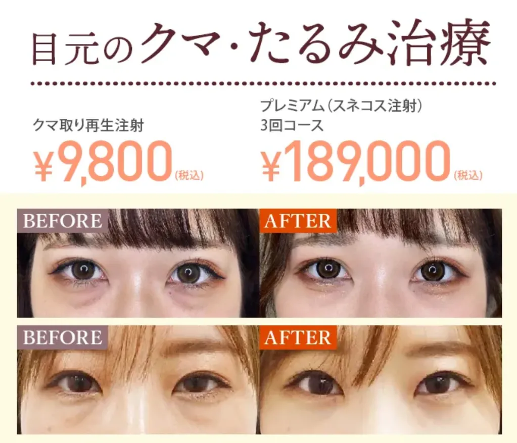 TCBの医療ローンで受けられる人気施術｜クマ取り再生注射施術症例