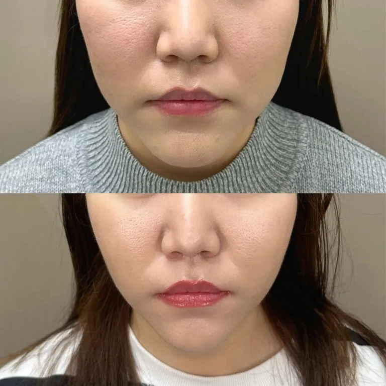 東京にあるTCBの中村 杏奈 医師のエラボトックスの症例写真