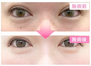 クマ取りの症例