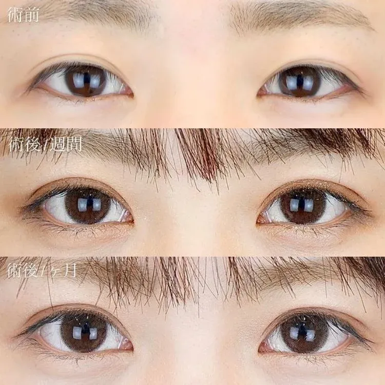 TCBの二重整形症例