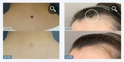 TCBのほくろ除去症例②