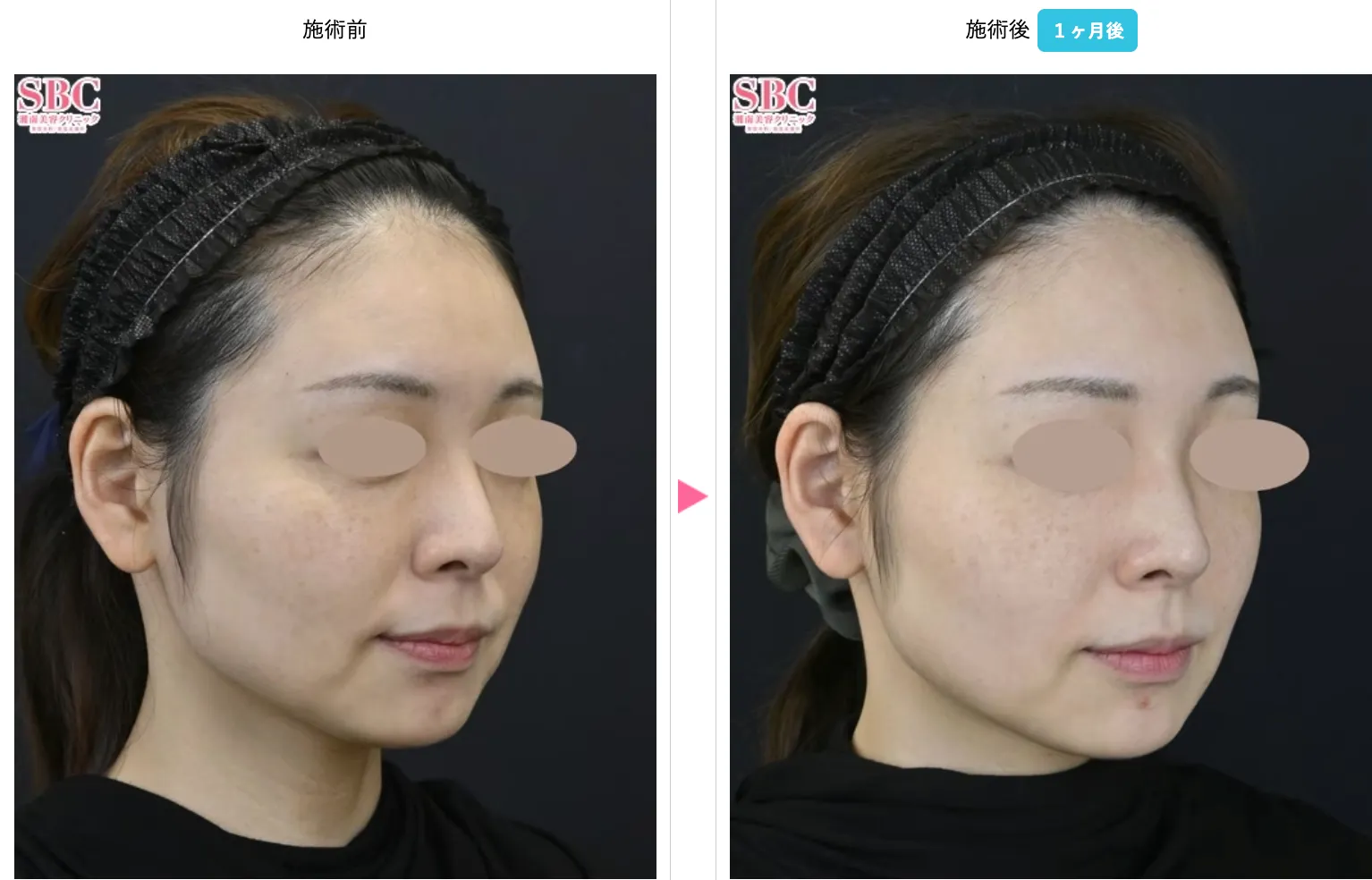 ジャルプロスーパーハイドロがキャンペーン価格で受けられるクリニックは？専門家が徹底調査｜SBCの症例写真１