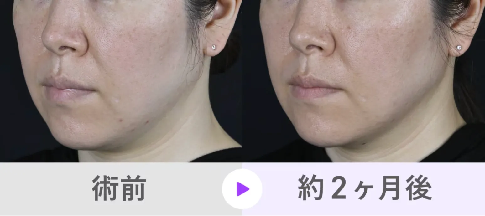 ジャルプロスーパーハイドロがキャンペーン価格で受けられるクリニックは？専門家が徹底調査｜SBCの症例写真２