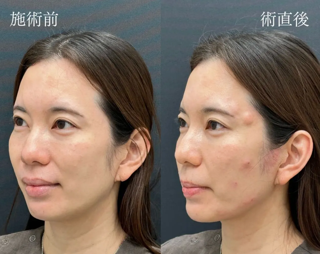 ジャルプロスーパーハイドロがキャンペーン価格で受けられるクリニックは？専門家が徹底調査｜施術直後の画像