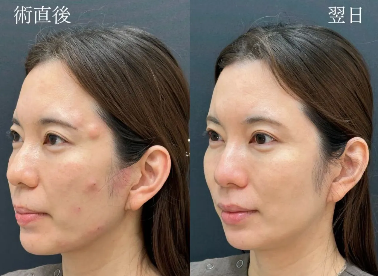 ジャルプロスーパーハイドロがキャンペーン価格で受けられるクリニックは？専門家が徹底調査｜施術直後から翌日の画像