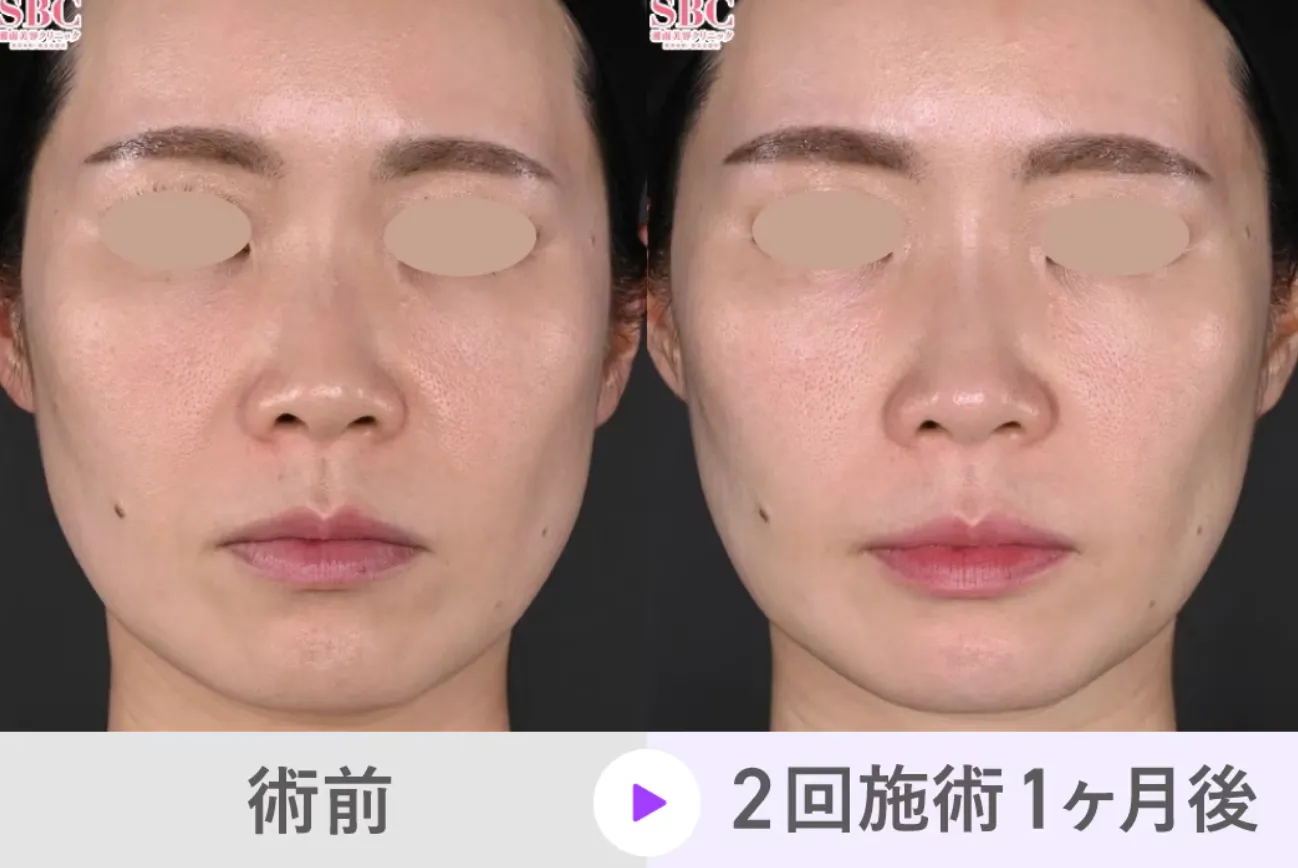 ジャルプロスーパーハイドロがキャンペーン価格で受けられるクリニックは？専門家が徹底調査｜SBCの症例写真３