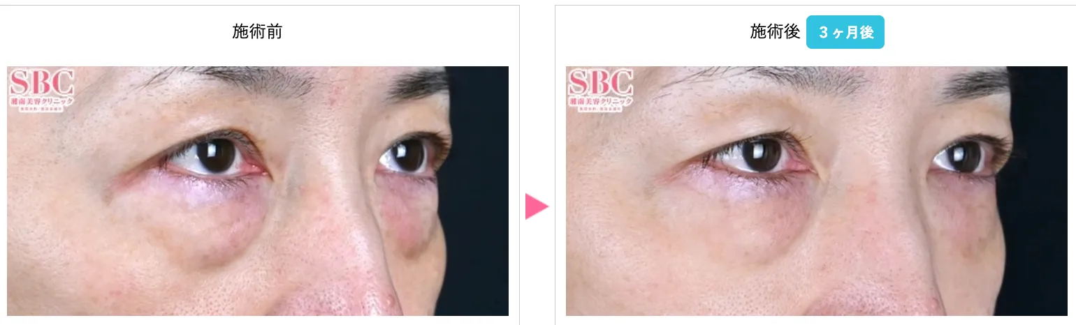モフィウス8がキャンペーン価格で受けられるクリニックは?専門家が徹底調査|SBCのモフィウス8の症例写真2