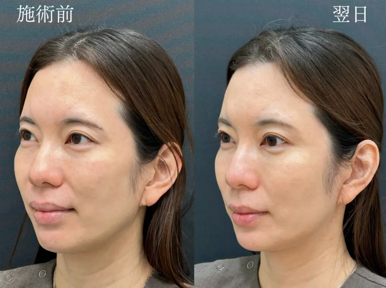 ジャルプロスーパーハイドロがキャンペーン価格で受けられるクリニックは？専門家が徹底調査｜施術前から翌日の画像