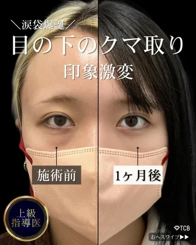 佐野医師のクマ取り症例