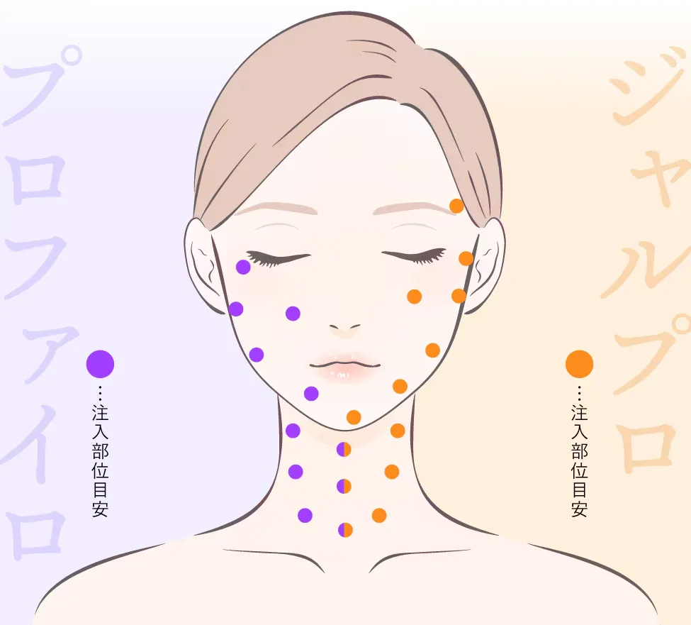 ジャルプロスーパーハイドロがキャンペーン価格で受けられるクリニックは？専門家が徹底調査｜ジャルプロの注入部位
