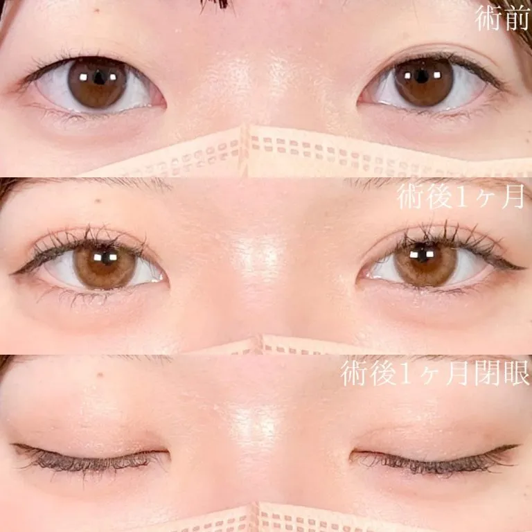 TCBの二重4,800円の症例