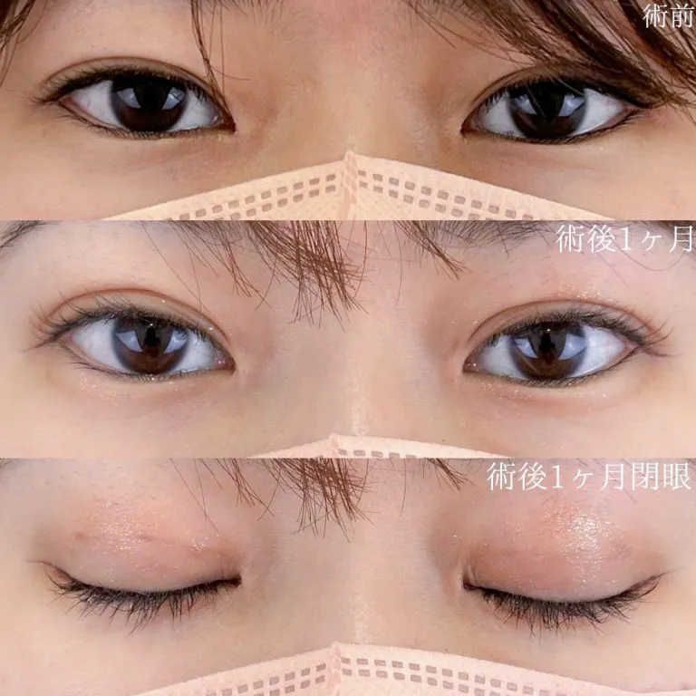 TCBの二重4,800円の症例