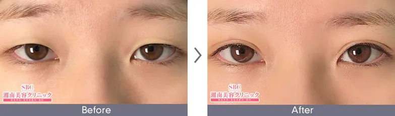 SBC湘南美容クリニックの4月の月替わりキャンペーン　二重整形の症例写真