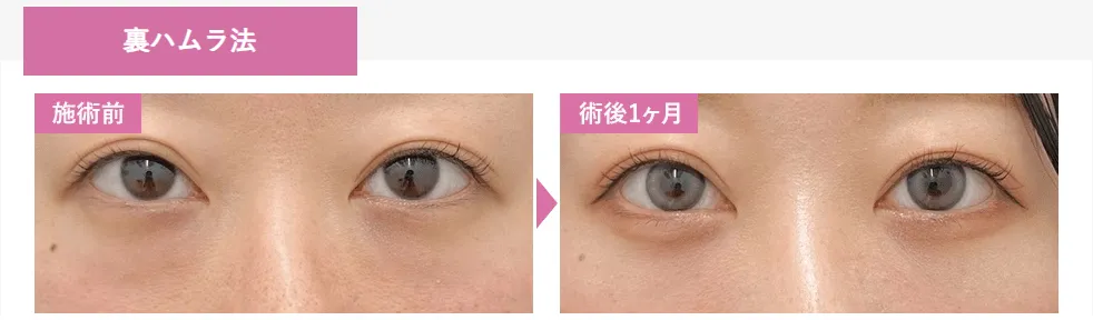 SBC湘南美容クリニックの4月の月替わりキャンペーン　クマ取りの症例写真②