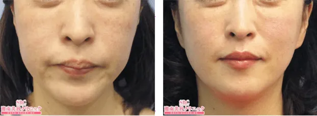 SBC湘南美容クリニックの4月の月替わりキャンペーン　糸リフトの症例写真③