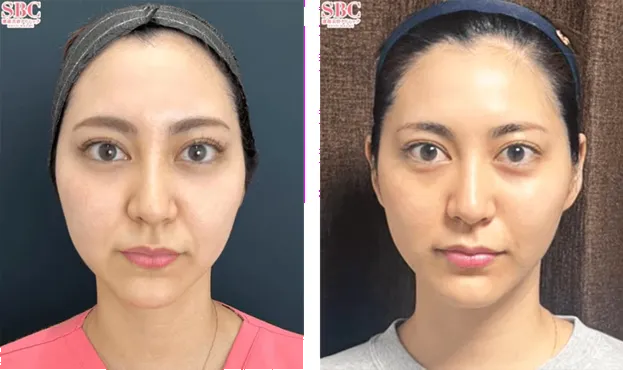 SBC湘南美容クリニックの4月の月替わりキャンペーン　糸リフトの症例写真②