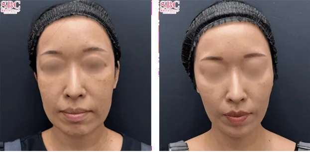 SBC湘南美容クリニックの4月の月替わりキャンペーン　糸リフトの症例写真①
