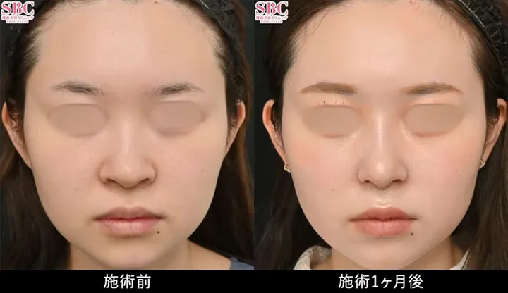SBC湘南美容クリニックの4月の月替わりキャンペーン　鼻整形の症例写真