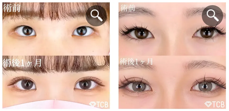 TCBの二重整形症例②