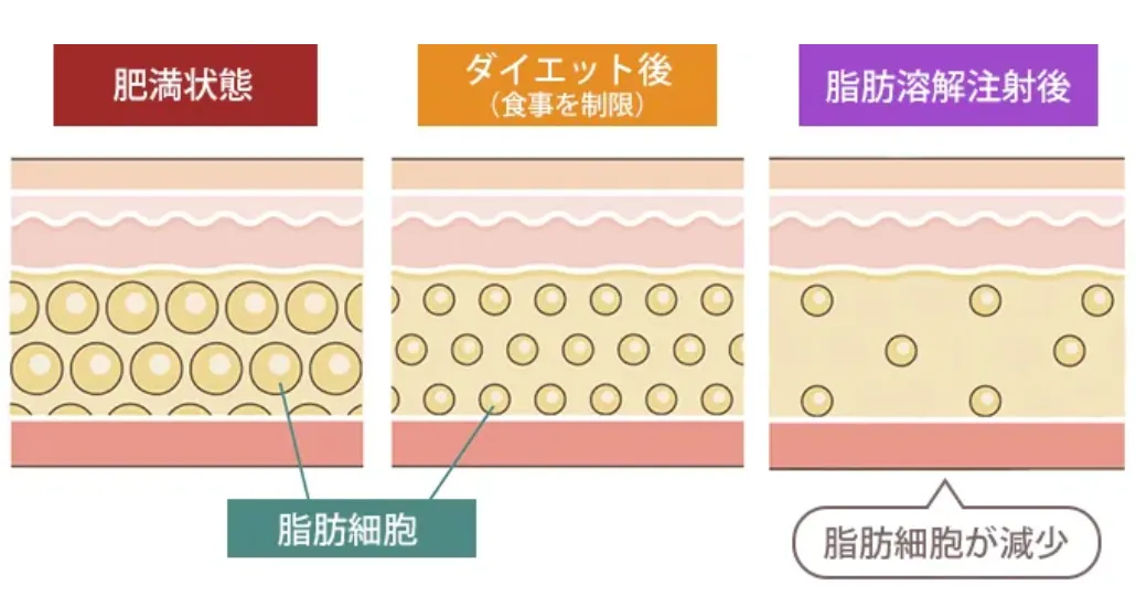 TCB 脂肪溶解注射 仕組み