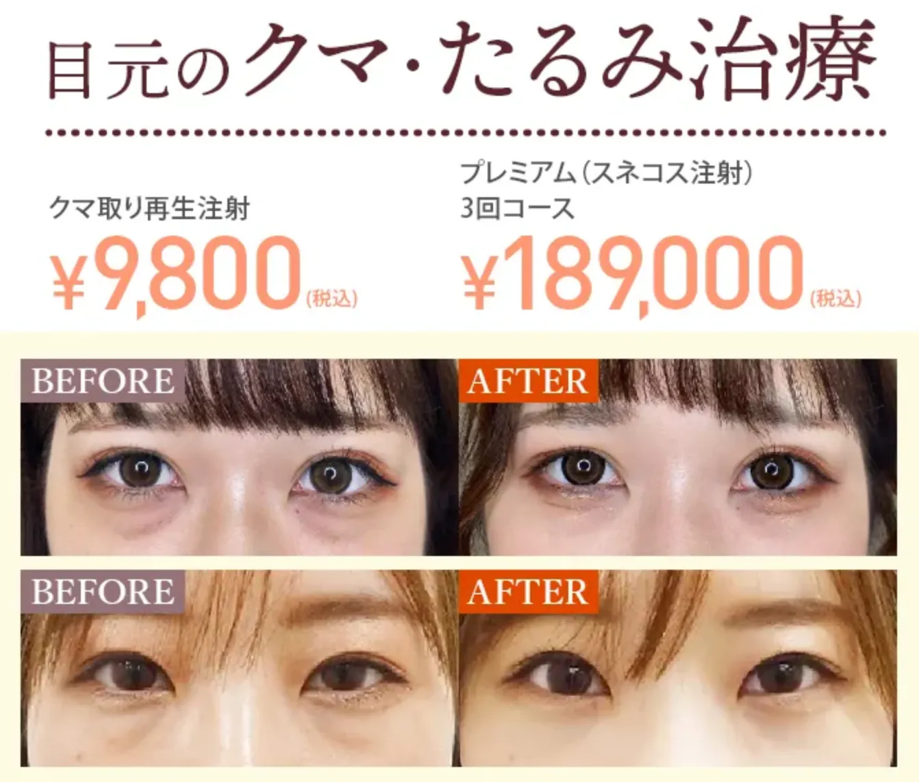 TCB クマ取り再生注射 症例写真