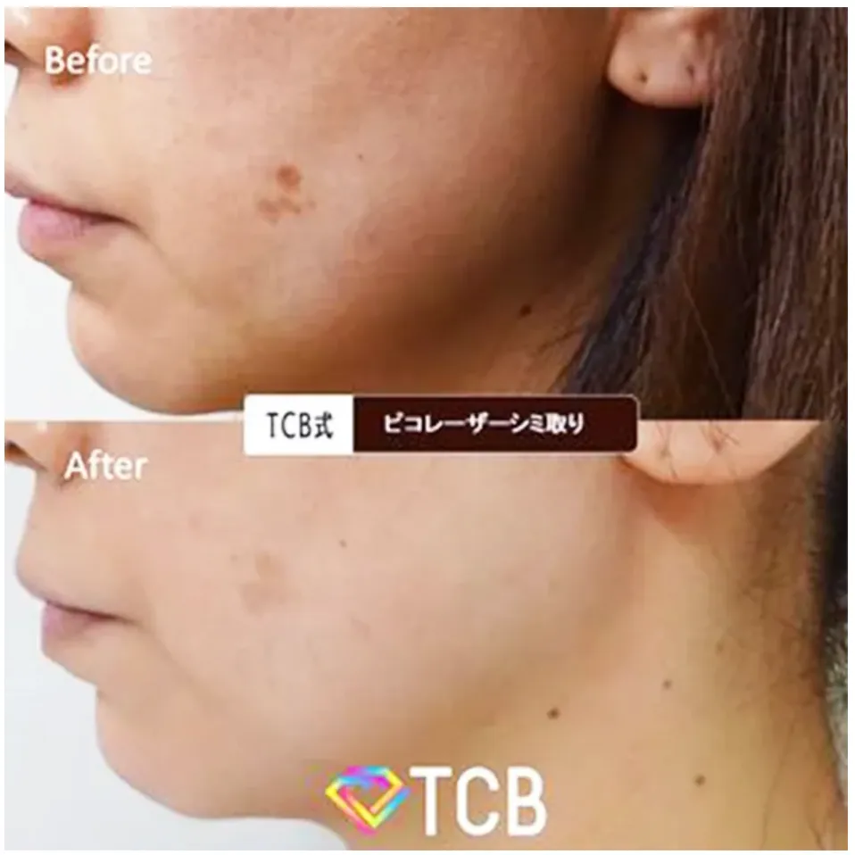 TCB ピコレーザー 症例写真