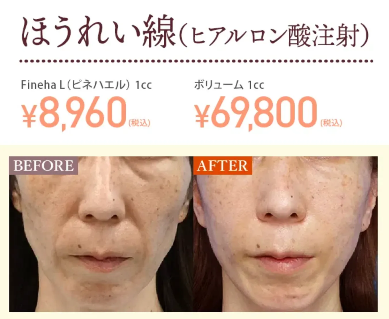 TCB ヒアルロン酸注射