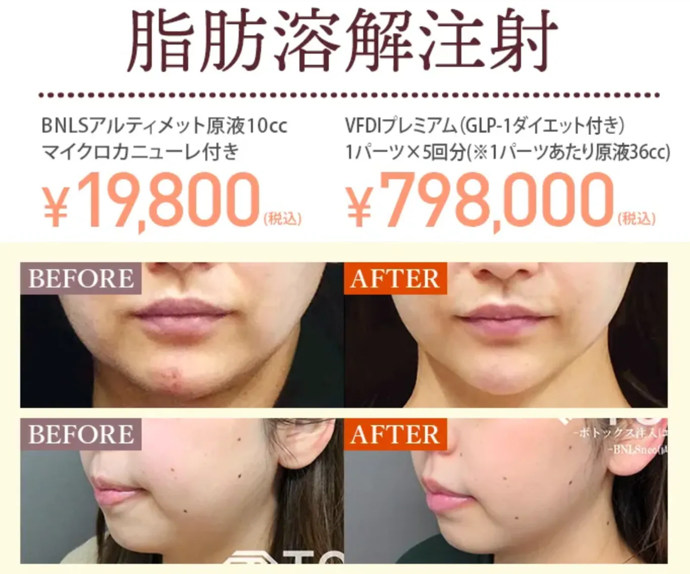 TCB 脂肪溶解注射 症例写真