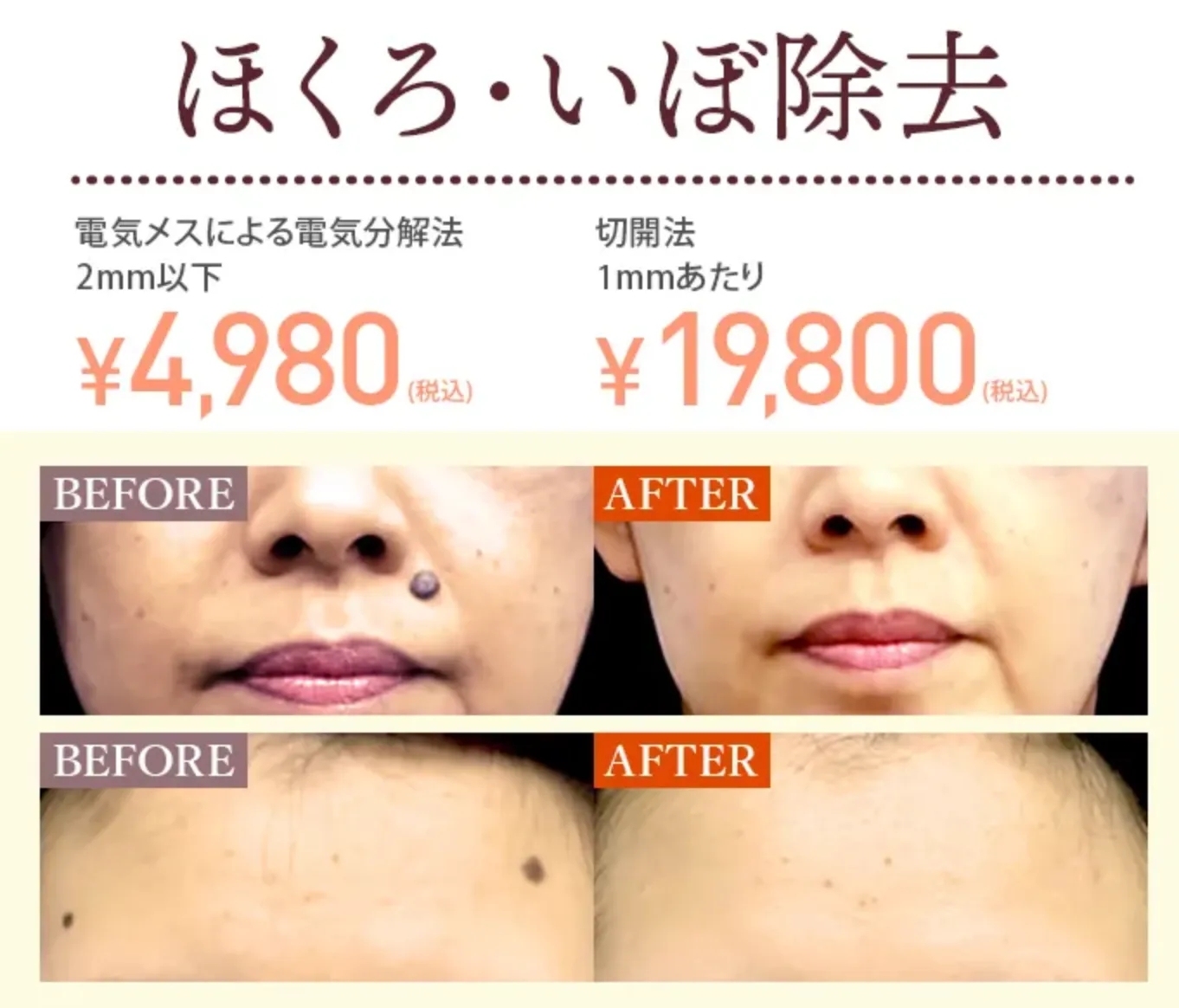 TCB ほくろ・イボ除去 症例写真