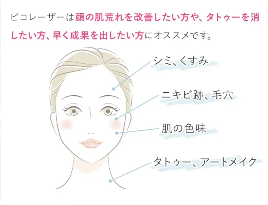 TCB ピコレーザー タトゥー除去