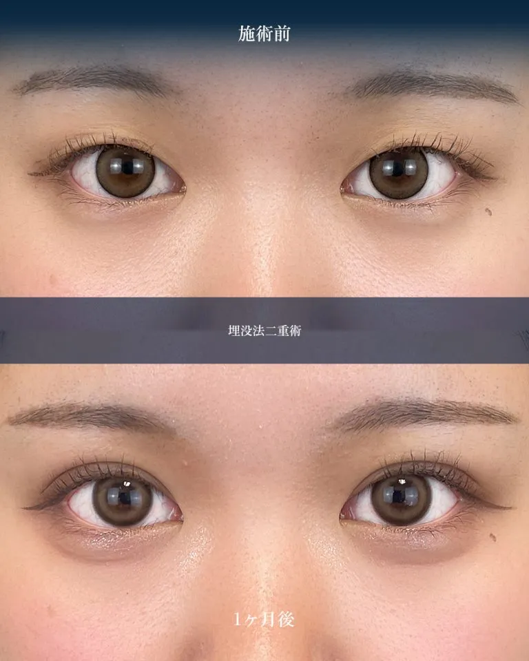 TCBの二重4,800円の症例