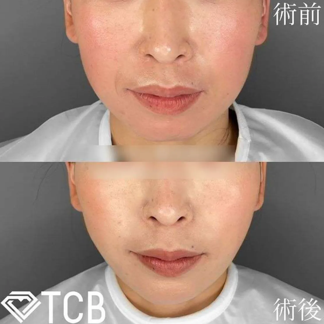 TCB糸リフト施術症例