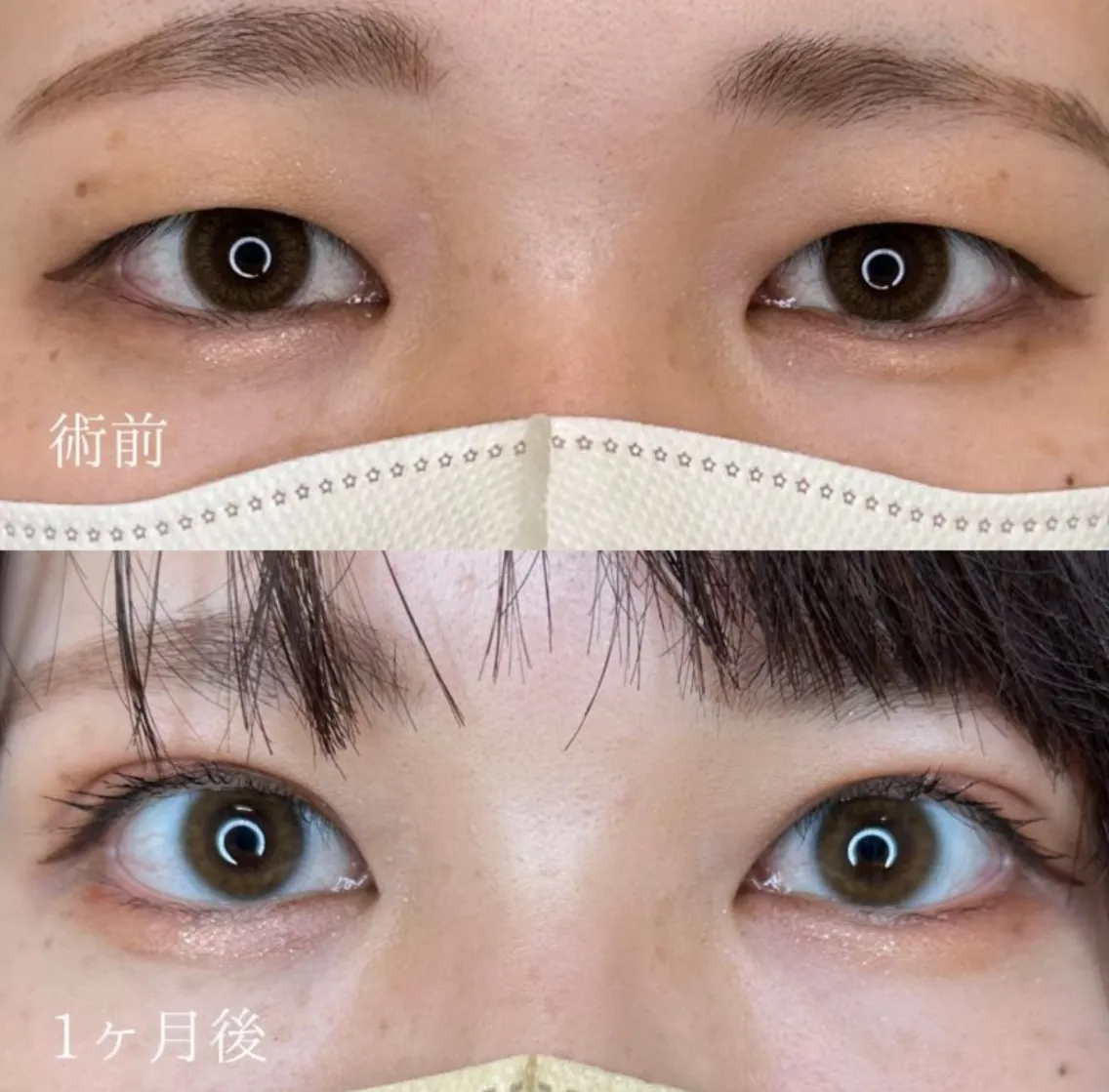 TCBの二重埋没の症例