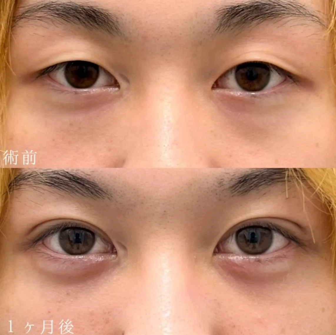 TCBの二重埋没の症例