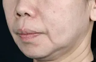 湘南美容クリニックのオンダリフトの症例1